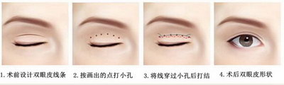 开个眼角前后_怎么去掉眼角鱼尾纹