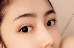 开眼角眼睛会不会变大(开眼角眼睛会不会变大)