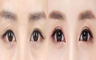 双眼皮刀口增生会好吗(什么是双眼皮刀口增生?)