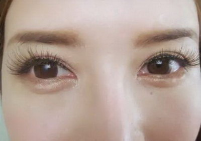 眼睛外斜视是怎么得的_眼睛热玛吉第5代疼吗