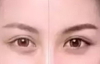 双眼皮抗疤痕用什么药(疤痕体质做双眼皮擦什么)