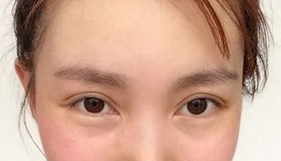 有眼袋了该怎么恢复[高度近视眼袋大怎么能恢复]