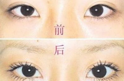 开眼角手术后多久又不红了(开眼角手术后恢复期要多久)