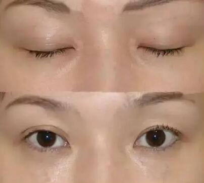 黑眼圈吃什么可以去除