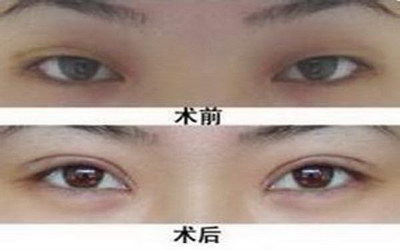 纳米无痕有双眼皮(纳米无痕双眼皮针)