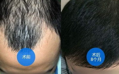 种植牙大概要几次(头发种植大概要几次)