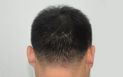 掉头发怎么治才是好？