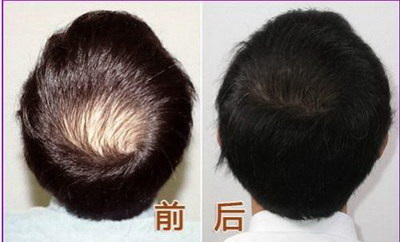 电脑一族为何掉头发呀？
