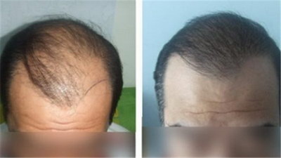 永久纹眼线和半永久的区别_单眼皮纹眼线效果图片