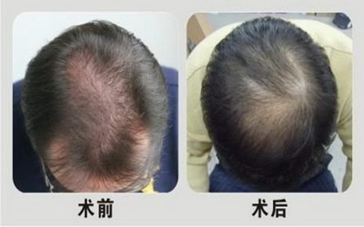 种植毛发哪个比较好(北京种植毛发哪个比较好)