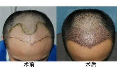 脸上汗毛过重怎么办(脸上都是汗毛怎么办)
