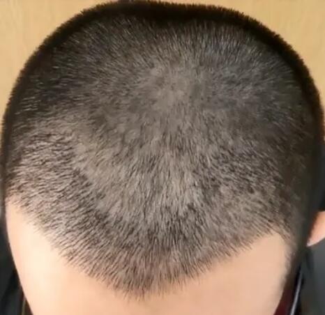 植发有什么有什么危害(植发有什么大的危害吗)