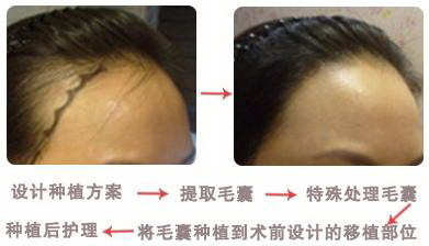 北京植发医院哪家好还选碧莲盛