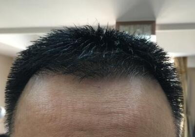 杭州种植毛发医院排名【杭州哪家医院种植毛发好】