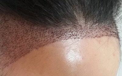 眼睛有倒睫毛怎么办(如何解决倒睫毛的问题)