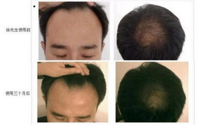 我的发际线在后移_有纹发际线的吗