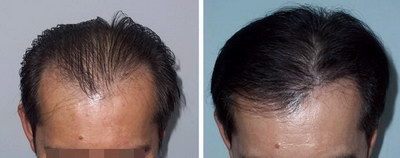 头顶头发稀少可以治吗_头顶头发稀少怎么植发