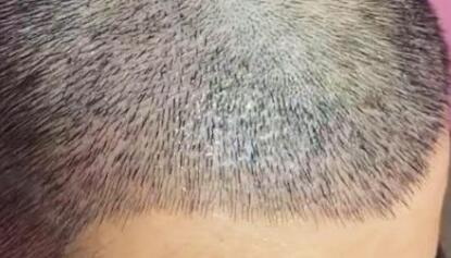 植发用什么方法操作最快[植发的方法是什么]