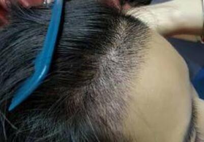 怎么才能去掉脸上的汗毛呢