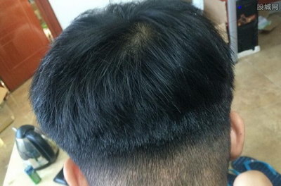 辐射会掉头发(为什么辐射会导致掉头发？)