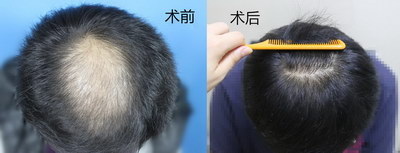 那些人不适合种睫毛？