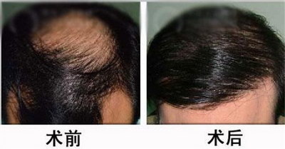 自体毛发移植效果谁做了都说好