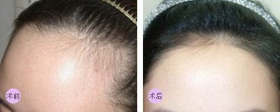 中医脱毛绝毛方法大全_中医脱毛绝毛方法