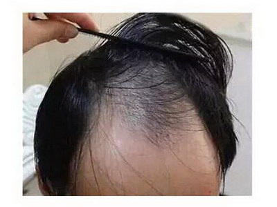 电头发能维持多久(种头发能维持多久)