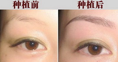脱发后又长出新头发(我的脱发经历与新头发的生长)