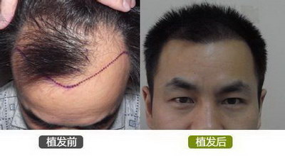 植发后掉了多久能长出来(植发多久后头发能长出来)