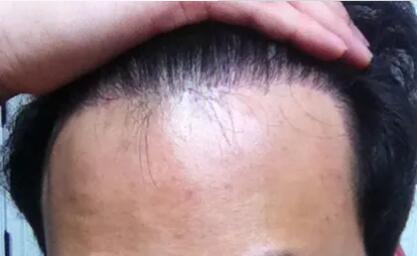 植发之后还会掉头发吗？