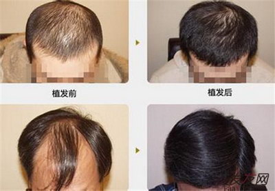 目前的植发手术一般费用是多少？
