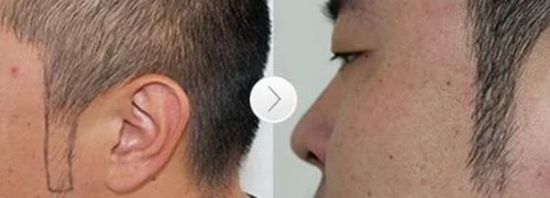 脸上汗毛重怎么解决男