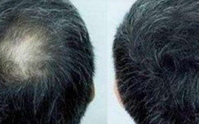 毛发移植术，解决你的烦恼没商量
