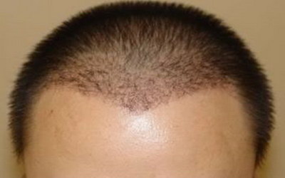 如何做植发生意赚钱(如何做植发生意)