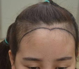 发际线掉头发会怎么样？