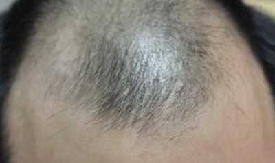 男生发际线低怎么做才好看(男生发际线低脑门窄怎么办)