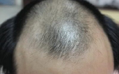 填充发际线多少钱_纹发际线多少钱